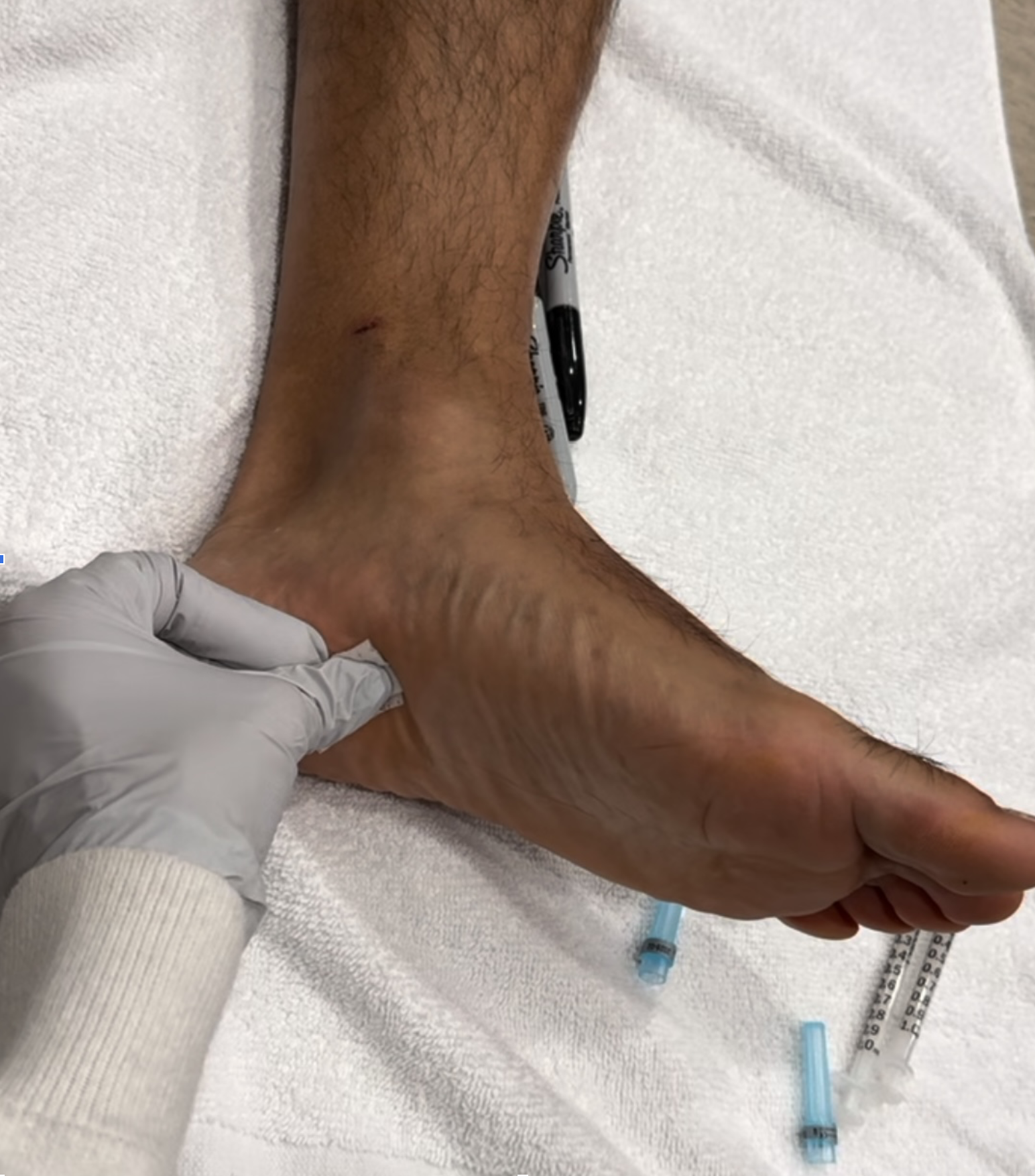 Injecting Botox for Plantar Fasciitis inflammation at Cosmetic Injectable Center in Sherman Oaks.